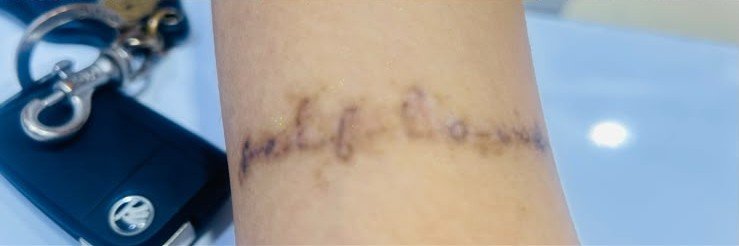 After tattoo fading