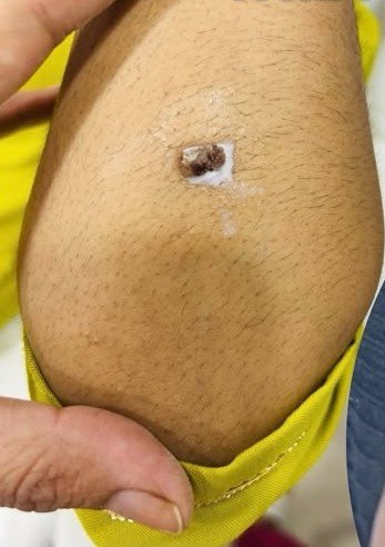 Before wart removal