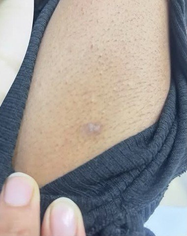 After wart removal