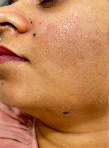 Before mole removal