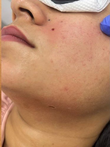After mole removal