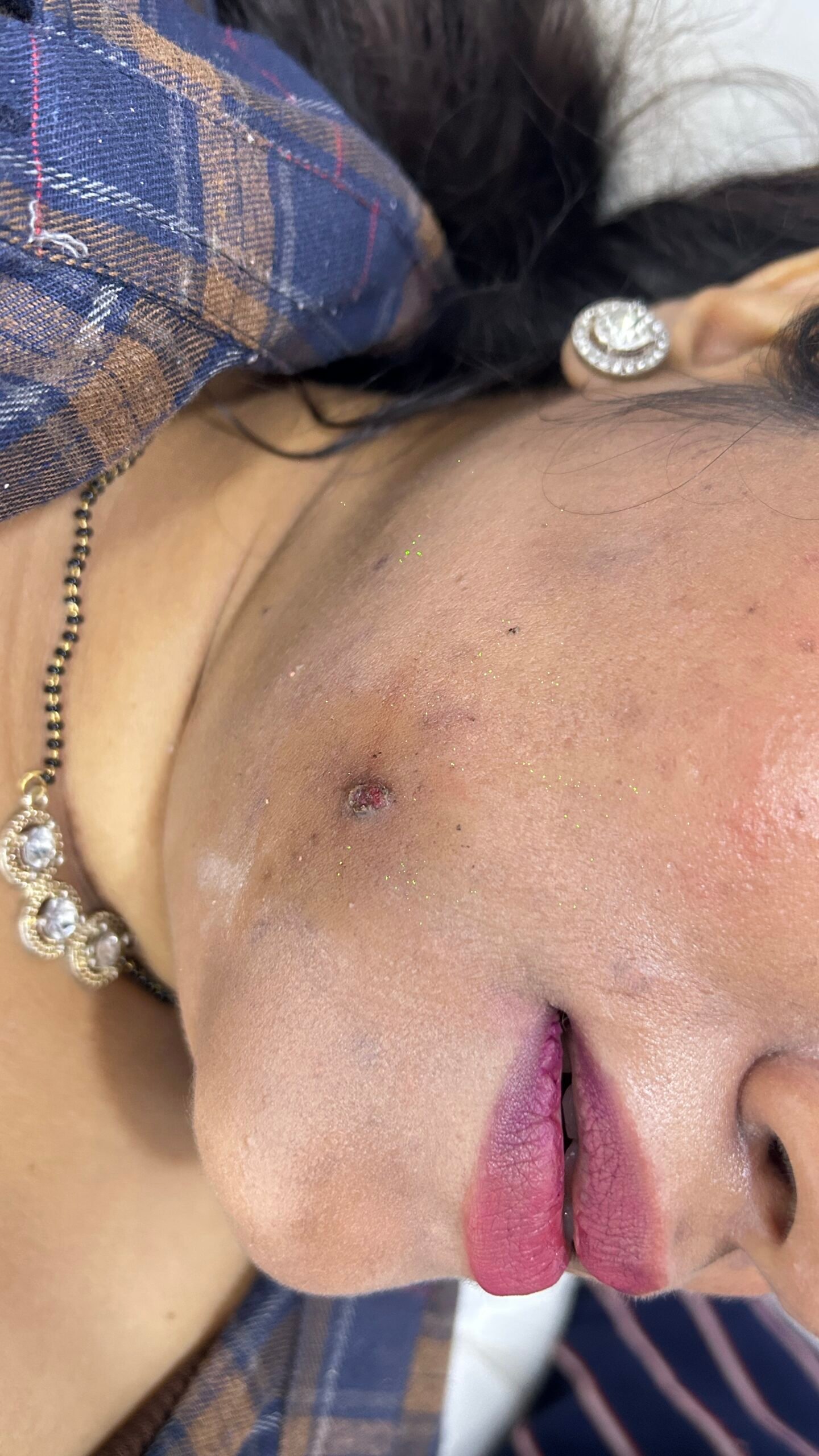 After acne improvement