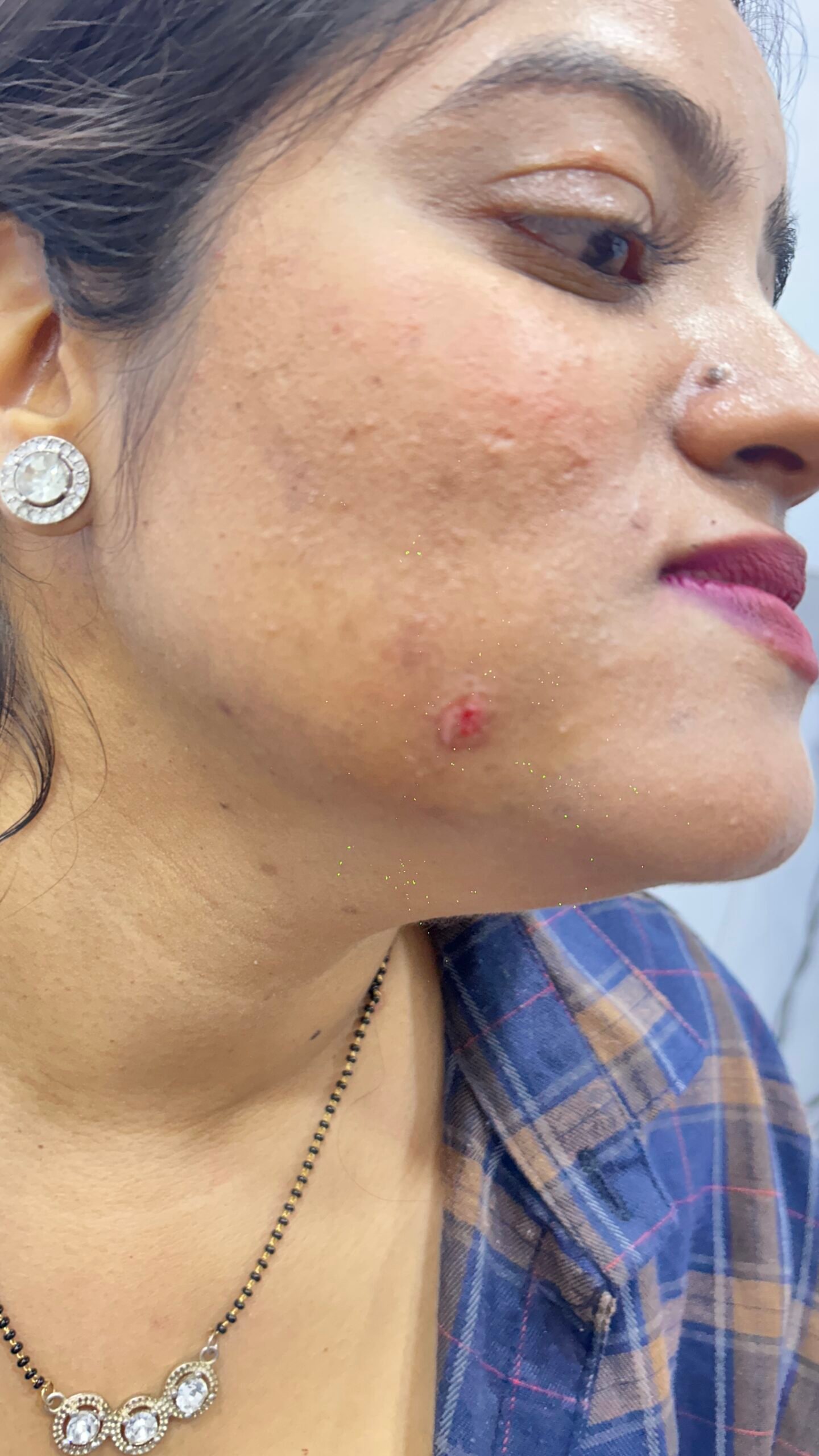 Before acne