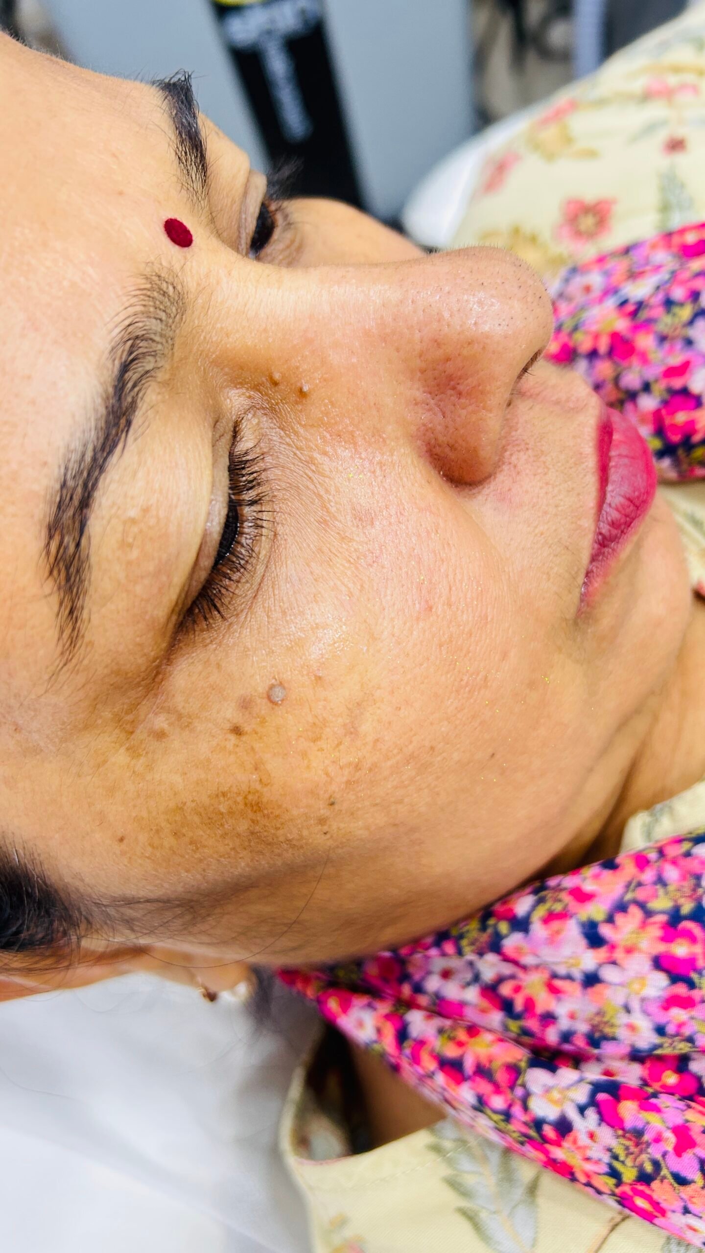 Before pigmentation
