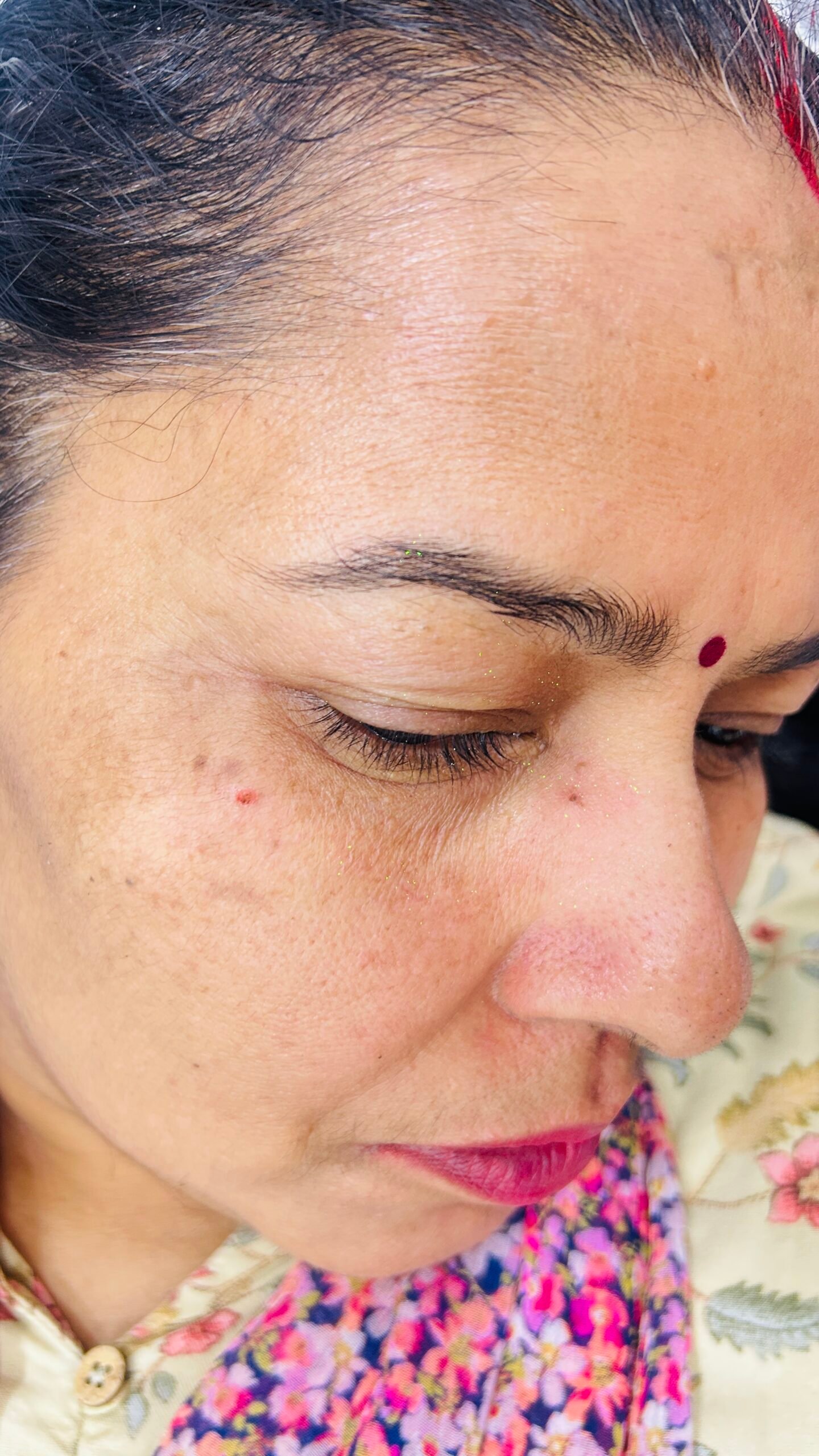 After pigmentation improvement