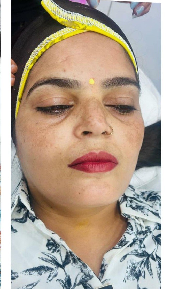 After facial pigmentation
