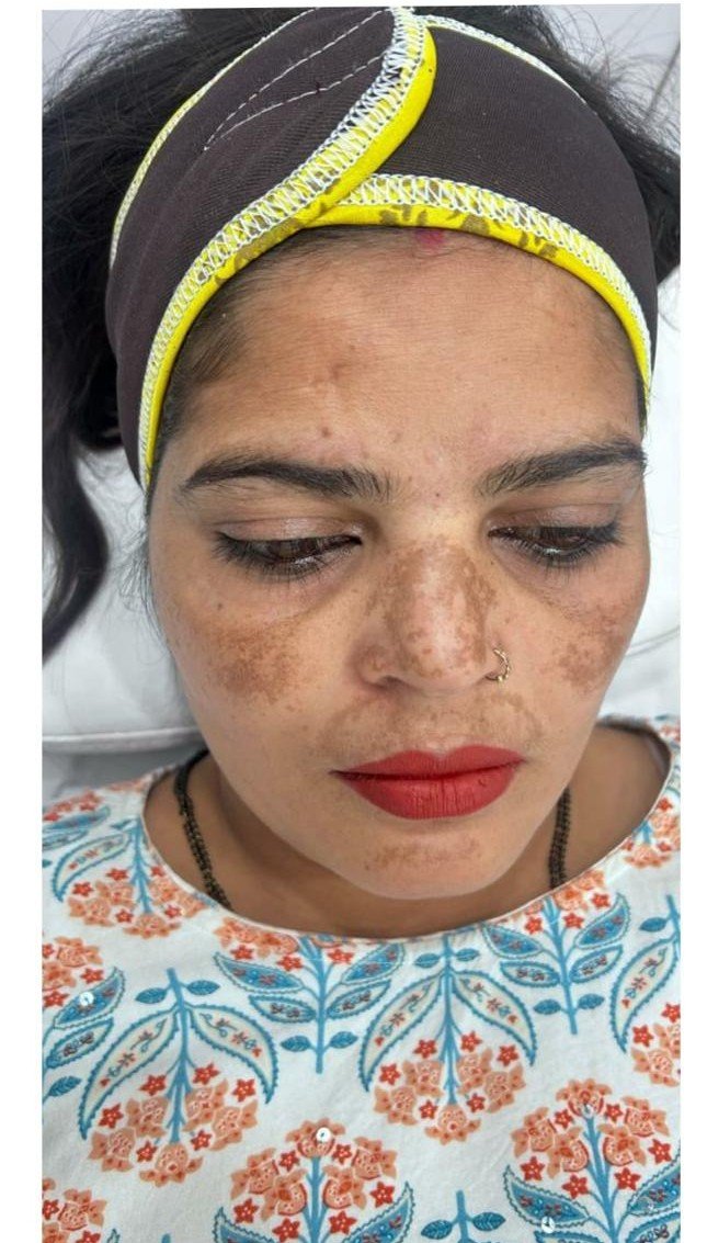 Before facial pigmentation